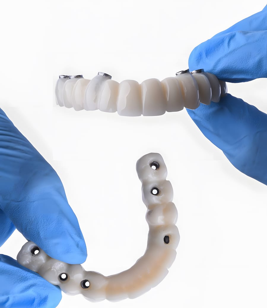 All-on-6 full arch dental implant prostheses at Greenfield Dental, Hanoi Vietnam