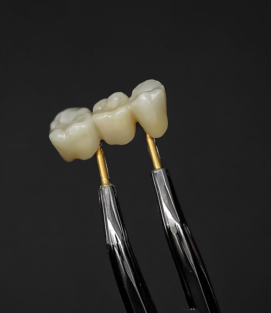 Zirconia dental bridge at Greenfield Dental, Hanoi Vietnam