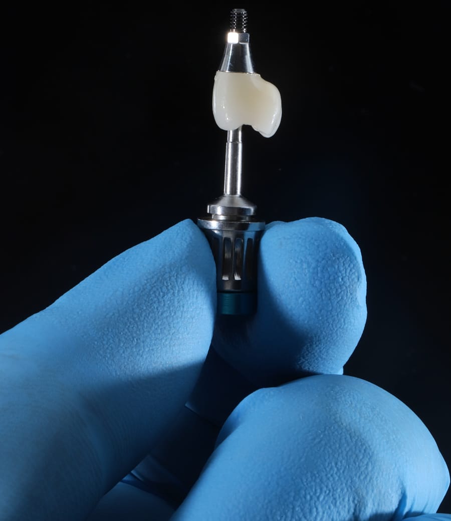 Single dental implant crown at Greenfield Dental, Hanoi Vietnam